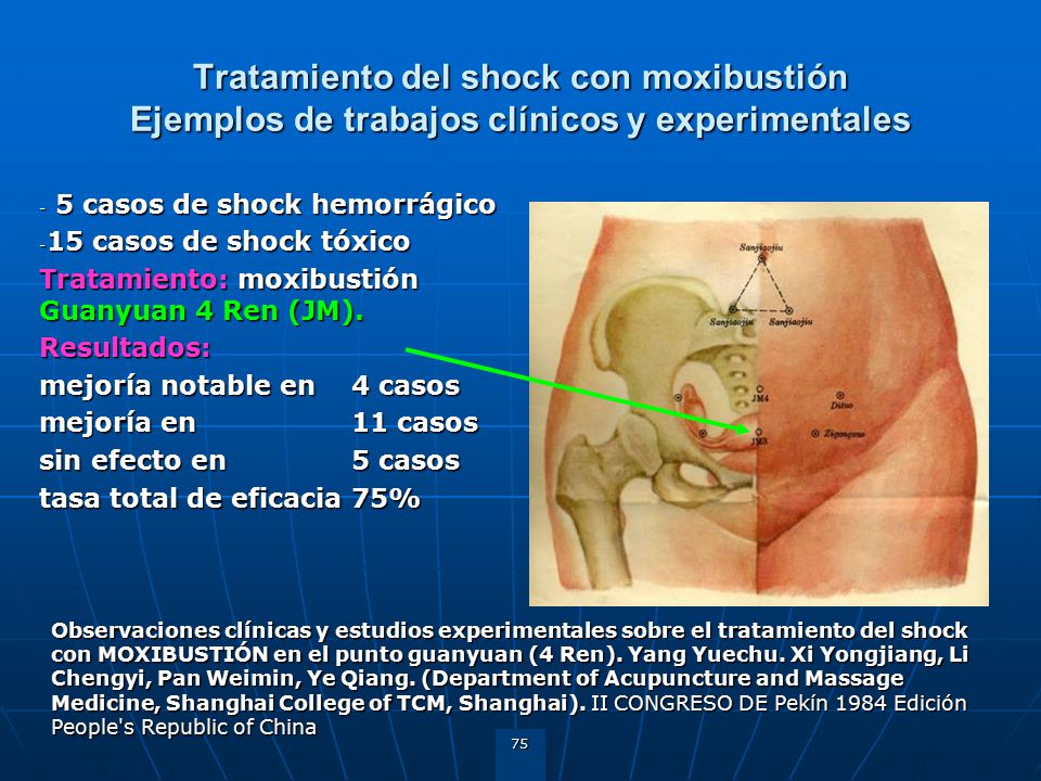 Tratamiento del shock con moxibustión Ejemplos de trabajos clínicos y experimentales