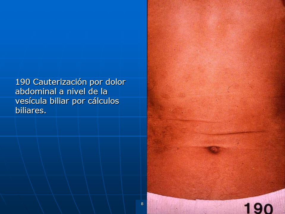190 Cauterización por dolor abdominal a nivel de la vesícula biliar por cálculos biliares.