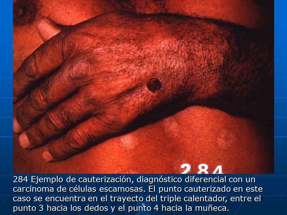 284 Ejemplo de cauterización, diagnóstico diferencial con un carcinoma de células escamosas.