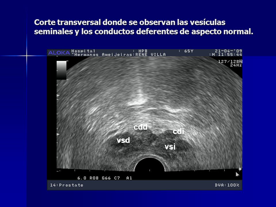 Corte transversal donde se observan las vesículas seminales y los conductos deferentes de aspecto normal.
