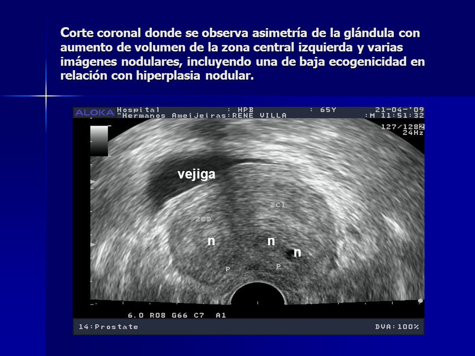 Corte coronal donde se observa asimetría de la glándula con aumento de volumen de la zona central izquierda y varias imágenes nodulares, incluyendo una de baja ecogenicidad en relación con hiperplasia nodular.