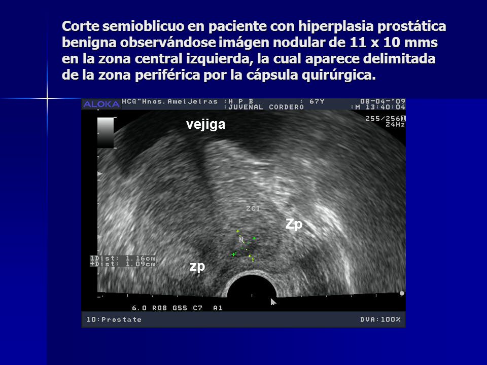 Corte semioblicuo en paciente con hiperplasia prostática benigna observándose imágen nodular de 11 x 10 mms en la zona central izquierda, la cual aparece delimitada de la zona periférica por la cápsula quirúrgica.
