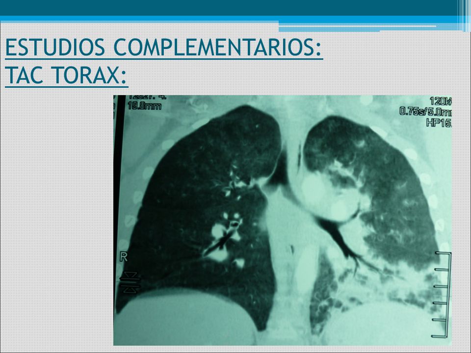 ESTUDIOS COMPLEMENTARIOS: TAC TORAX: