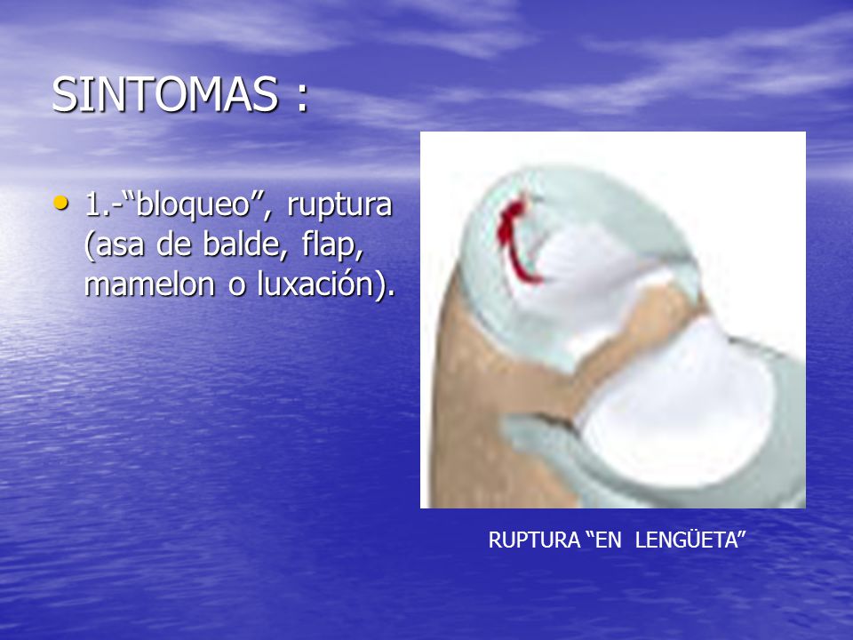 SINTOMAS : 1.- bloqueo , ruptura (asa de balde, flap, mamelon o luxación). RUPTURA EN LENGÜETA