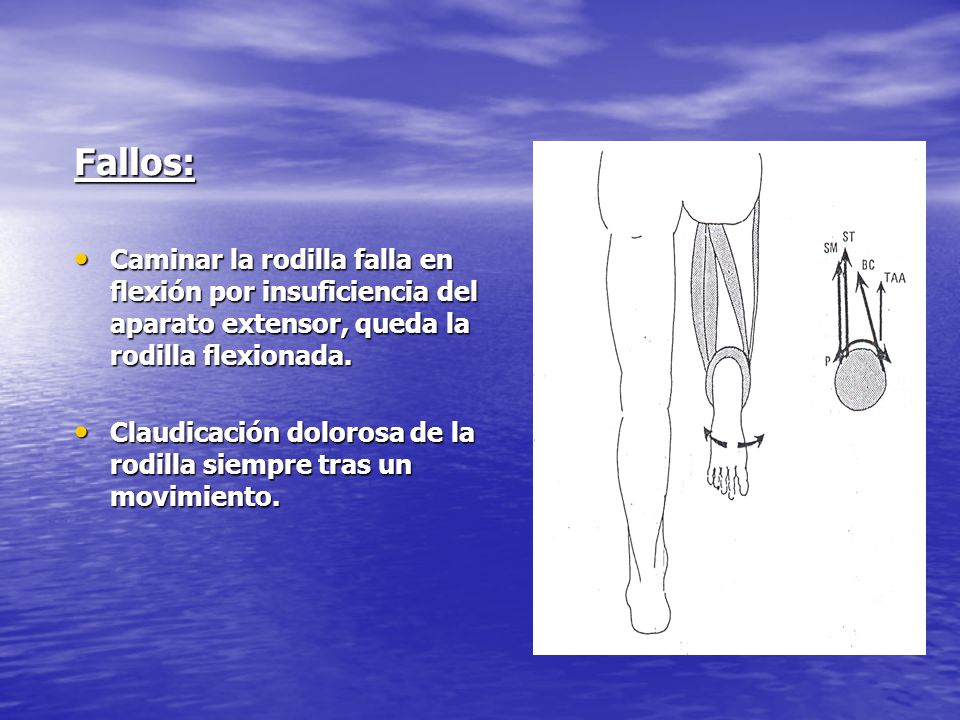Fallos: Caminar la rodilla falla en flexión por insuficiencia del aparato extensor, queda la rodilla flexionada.
