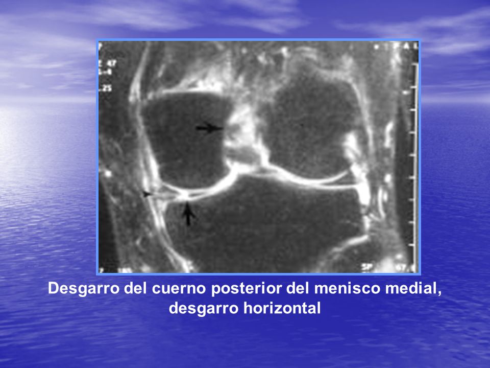 Desgarro del cuerno posterior del menisco medial, desgarro horizontal
