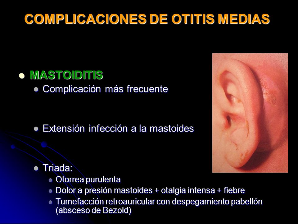 COMPLICACIONES DE OTITIS MEDIAS
