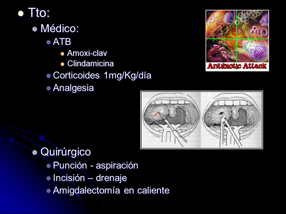 Tto: Médico: Quirúrgico ATB Corticoides 1mg/Kg/día Analgesia