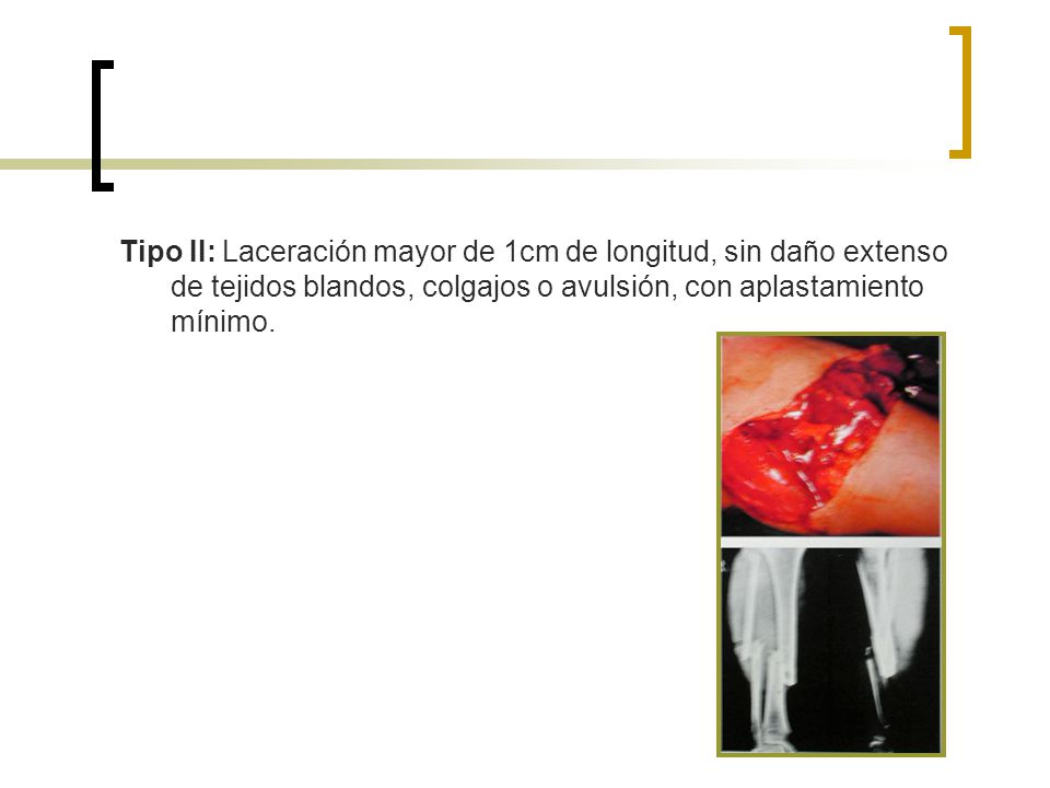 Tipo II: Laceración mayor de 1cm de longitud, sin daño extenso de tejidos blandos, colgajos o avulsión, con aplastamiento mínimo.