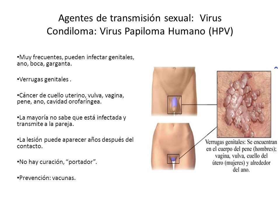 Agentes de transmisión sexual: Virus Condiloma: Virus Papiloma Humano (HPV)