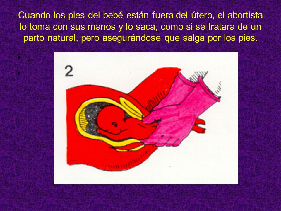 Cuando los pies del bebé están fuera del útero, el abortista lo toma con sus manos y lo saca, como si se tratara de un parto natural, pero asegurándose que salga por los pies.