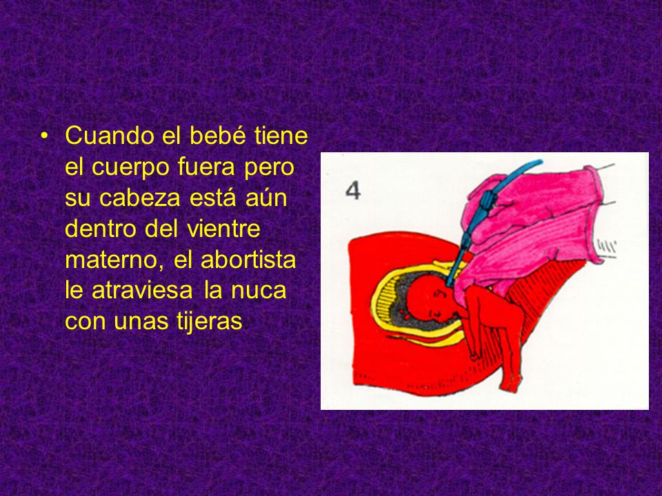 Cuando el bebé tiene el cuerpo fuera pero su cabeza está aún dentro del vientre materno, el abortista le atraviesa la nuca con unas tijeras.