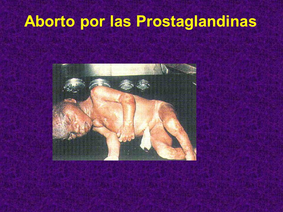 Aborto por las Prostaglandinas