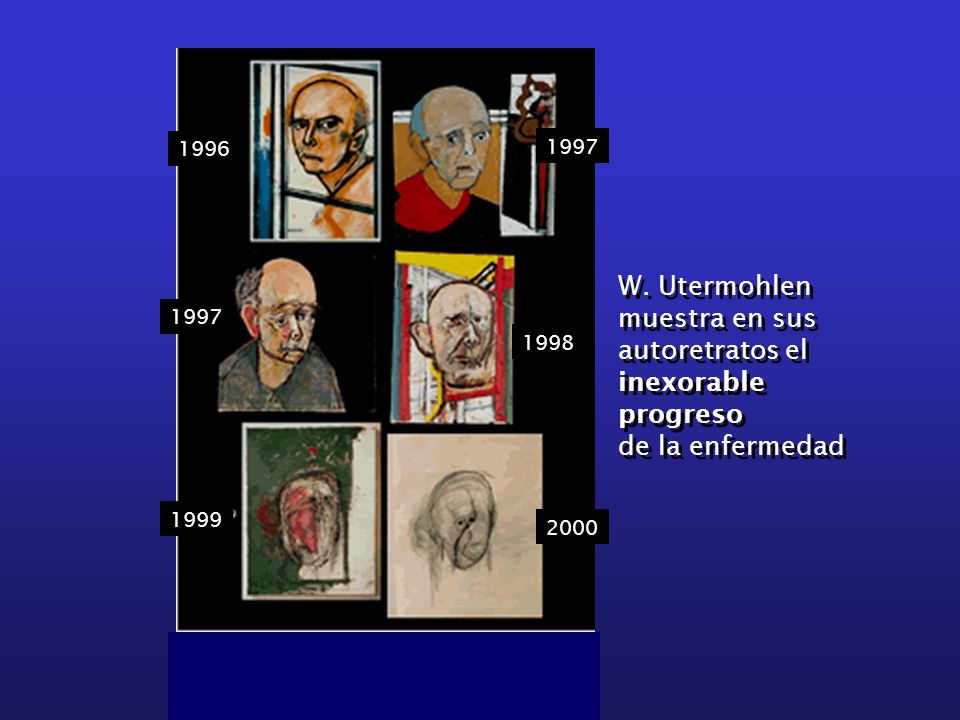 W. Utermohlen muestra en sus autoretratos el inexorable progreso