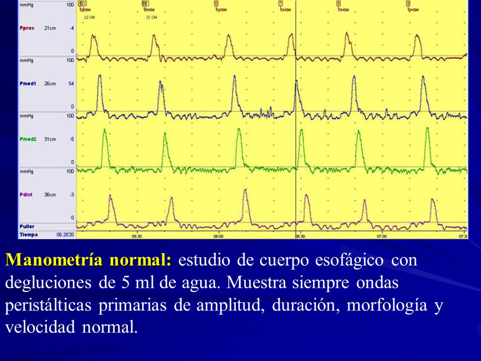 Manometría normal: estudio de cuerpo esofágico con degluciones de 5 ml de agua.