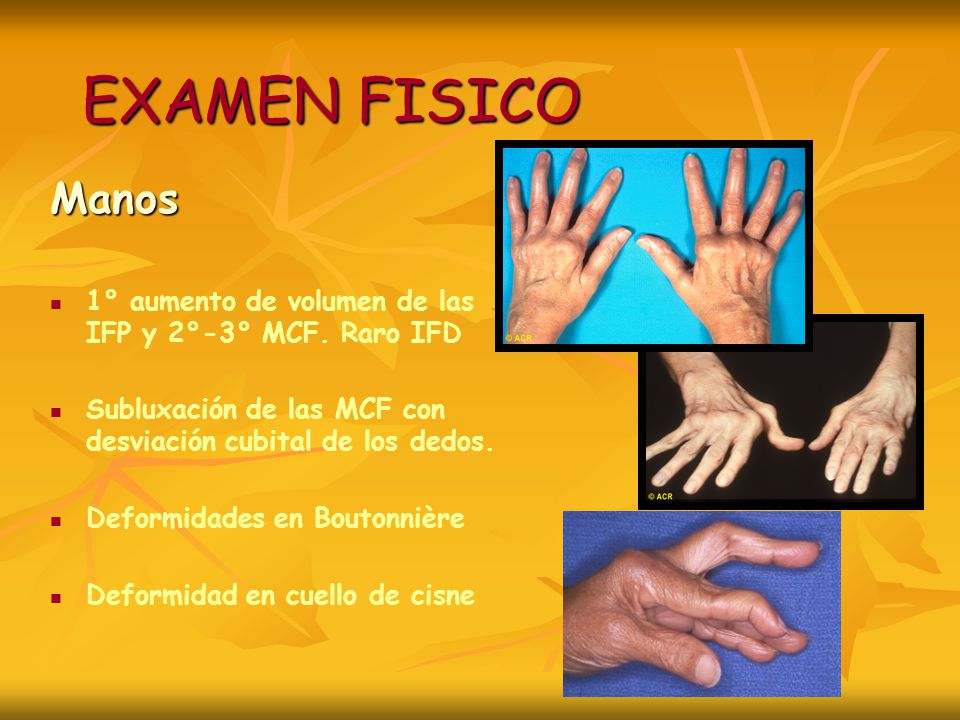 EXAMEN FISICO Manos. 1° aumento de volumen de las IFP y 2°-3° MCF. Raro IFD. Subluxación de las MCF con desviación cubital de los dedos.