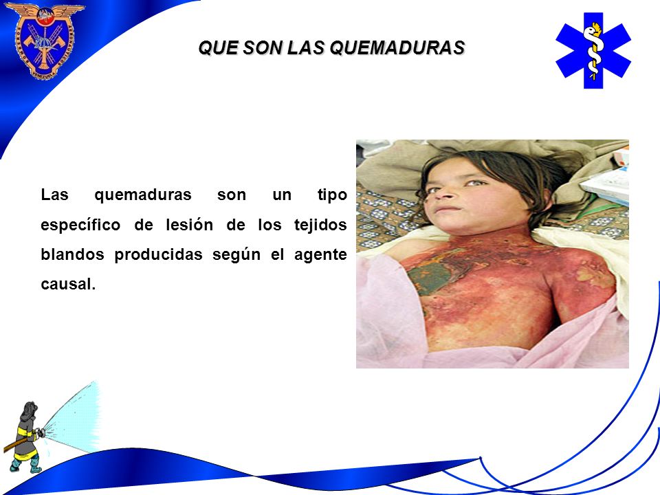 QUE SON LAS QUEMADURAS Las quemaduras son un tipo específico de lesión de los tejidos blandos producidas según el agente causal.