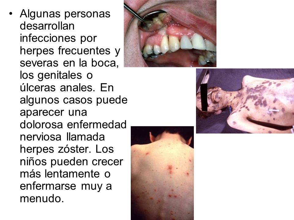 Algunas personas desarrollan infecciones por herpes frecuentes y severas en la boca, los genitales o úlceras anales.