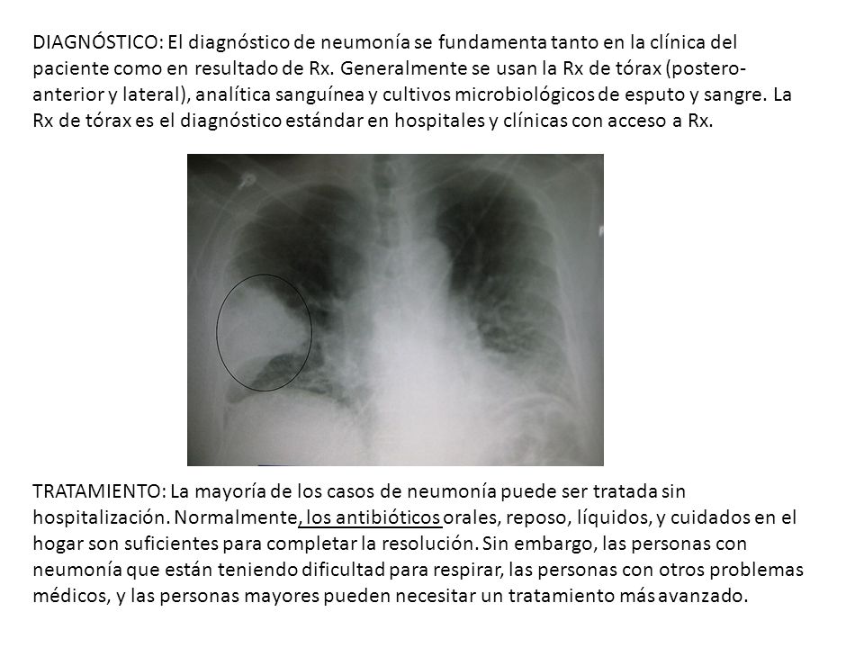 DIAGNÓSTICO: El diagnóstico de neumonía se fundamenta tanto en la clínica del paciente como en resultado de Rx. Generalmente se usan la Rx de tórax (postero-anterior y lateral), analítica sanguínea y cultivos microbiológicos de esputo y sangre. La Rx de tórax es el diagnóstico estándar en hospitales y clínicas con acceso a Rx.