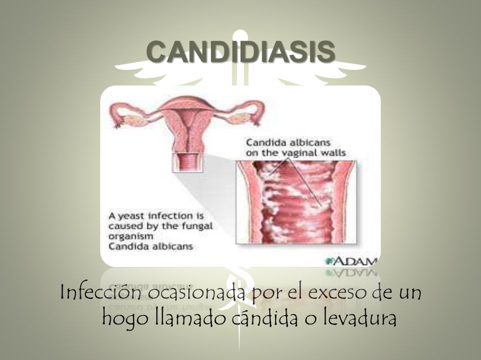 CANDIDIASIS Infección ocasionada por el exceso de un hogo llamado cándida o levadura