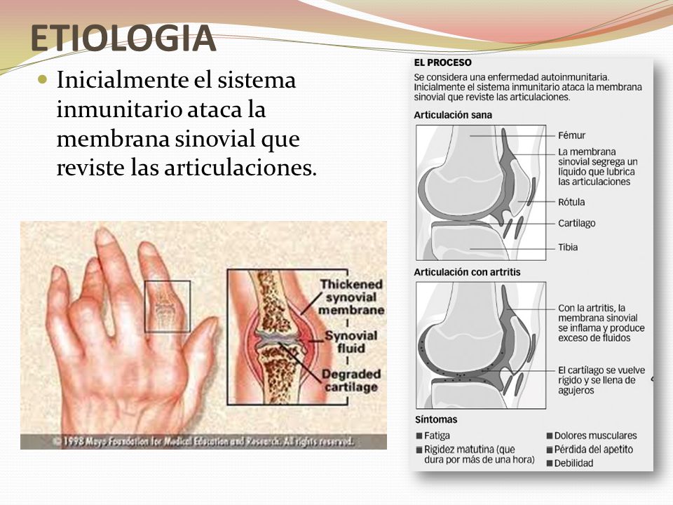ETIOLOGIA Inicialmente el sistema inmunitario ataca la membrana sinovial que reviste las articulaciones.