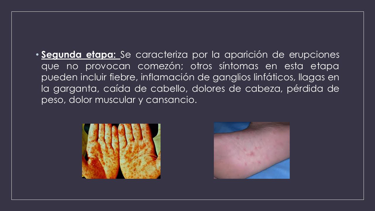 Segunda etapa: Se caracteriza por la aparición de erupciones que no provocan comezón; otros síntomas en esta etapa pueden incluir fiebre, inflamación de ganglios linfáticos, llagas en la garganta, caída de cabello, dolores de cabeza, pérdida de peso, dolor muscular y cansancio.