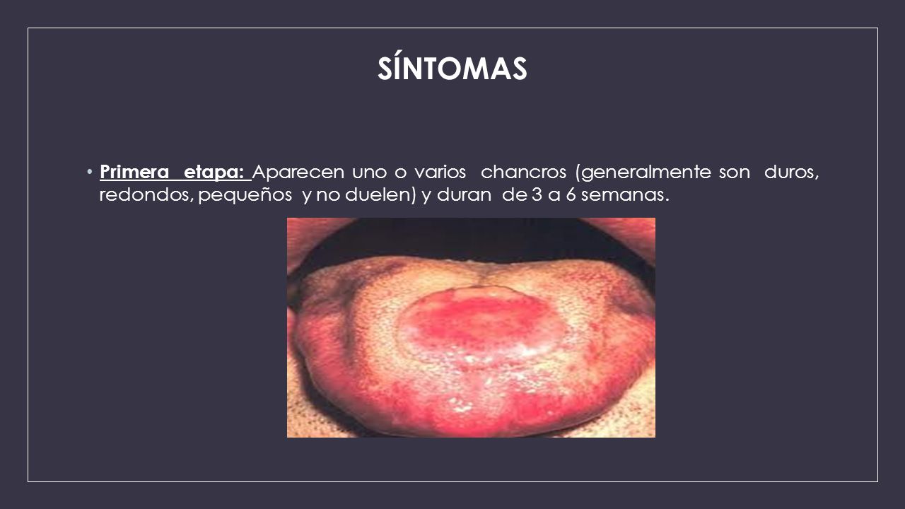 SÍNTOMAS Primera etapa: Aparecen uno o varios chancros (generalmente son duros, redondos, pequeños y no duelen) y duran de 3 a 6 semanas.