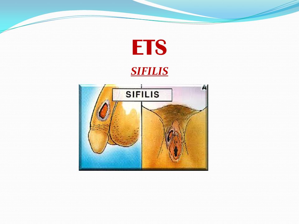 ETS SIFILIS