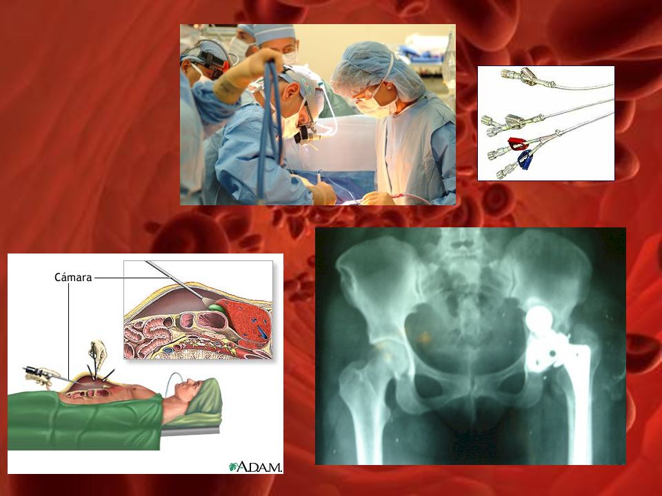 Cualquier cirugía, sobre todo, abdominal y de cadera.