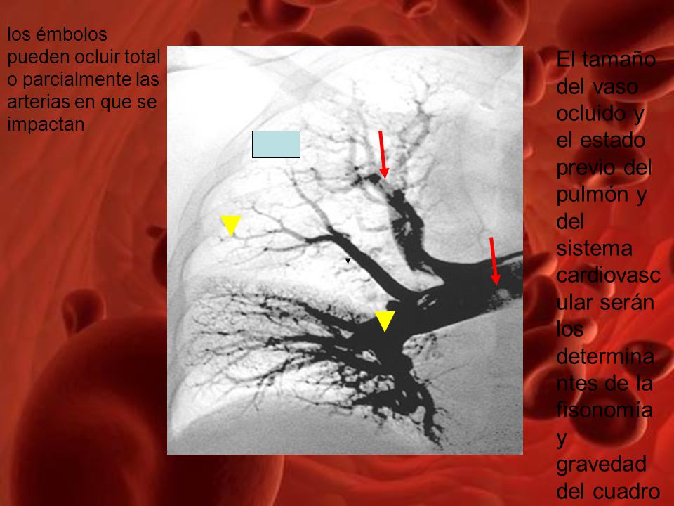 los émbolos pueden ocluir total o parcialmente las arterias en que se impactan