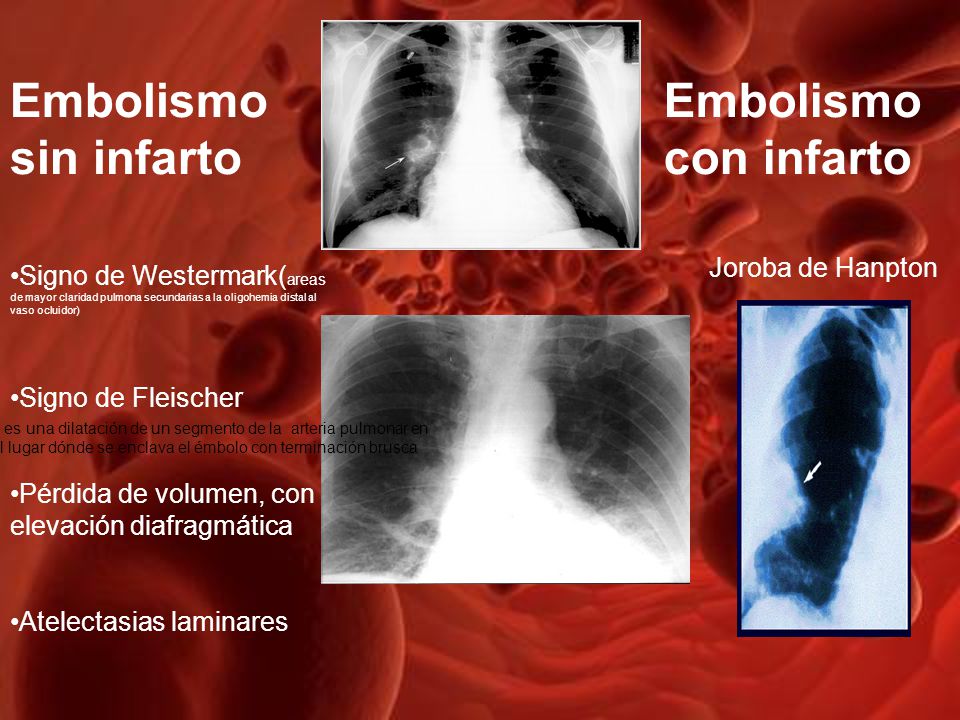 Embolismo sin infarto Embolismo con infarto Joroba de Hanpton