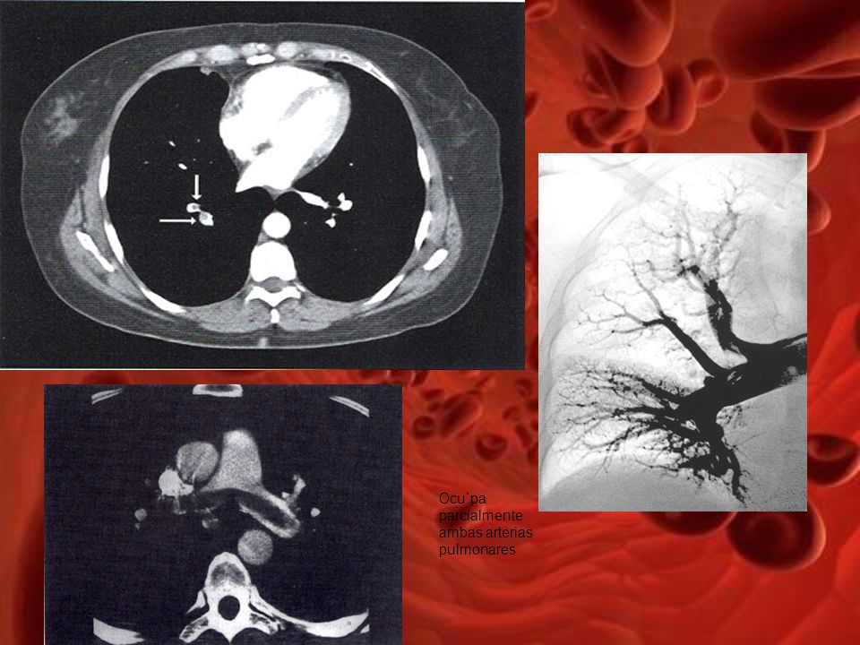 La limitación más importante de la angiotac pulmonar es la detección de trombos subsegmentarios aislados. Su sensibilidad baja hasta un 63% cuando se consideran estos vasos