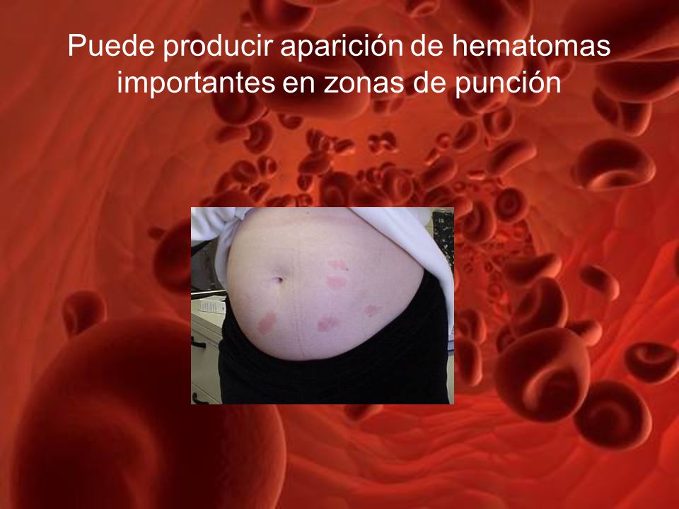 Puede producir aparición de hematomas importantes en zonas de punción