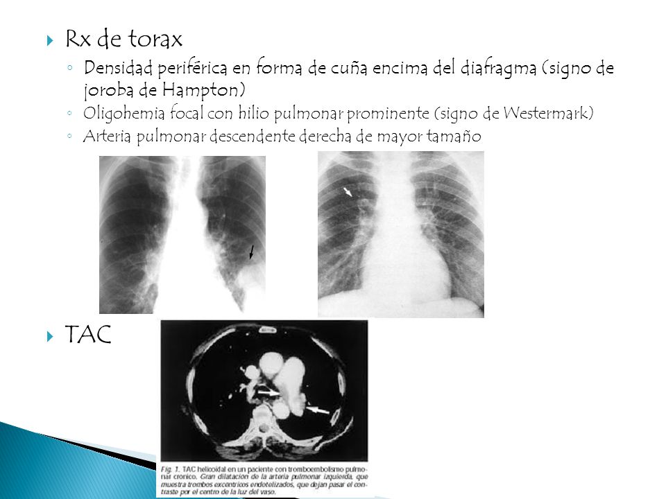 Rx de torax Densidad periférica en forma de cuña encima del diafragma (signo de joroba de Hampton)