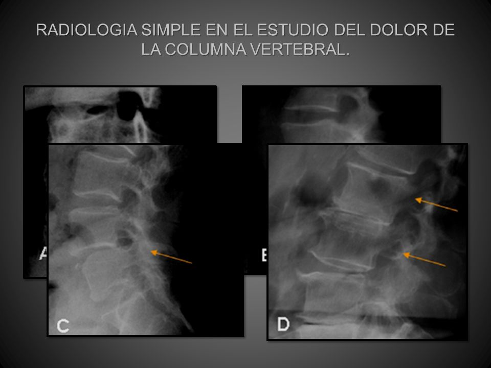 RADIOLOGIA SIMPLE EN EL ESTUDIO DEL DOLOR DE LA COLUMNA VERTEBRAL.
