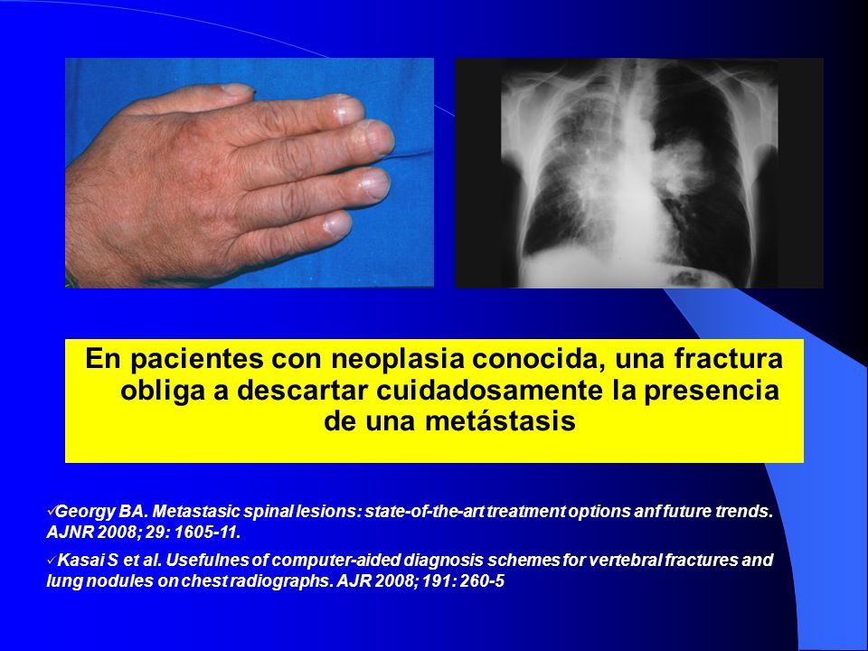 En pacientes con neoplasia conocida, una fractura obliga a descartar cuidadosamente la presencia de una metástasis