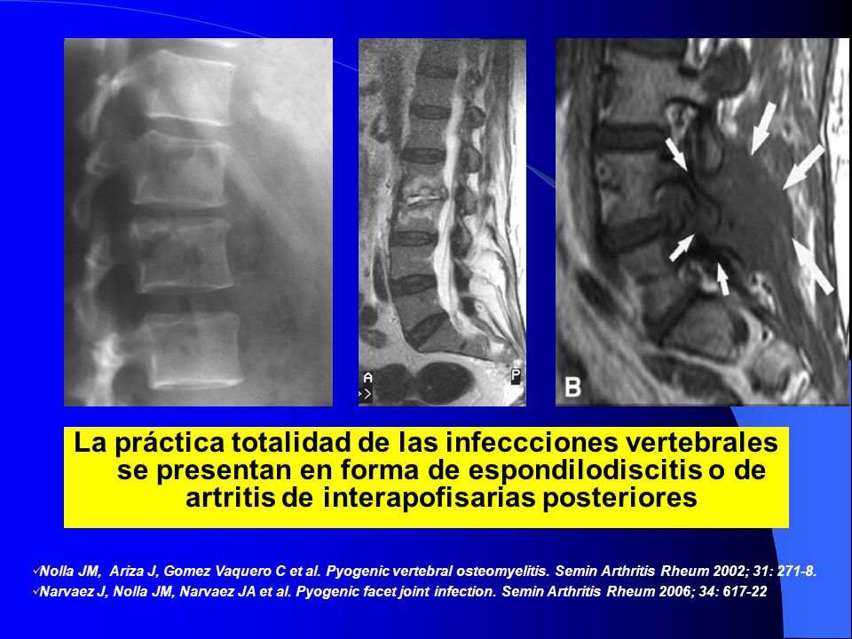 La práctica totalidad de las infeccciones vertebrales se presentan en forma de espondilodiscitis o de artritis de interapofisarias posteriores