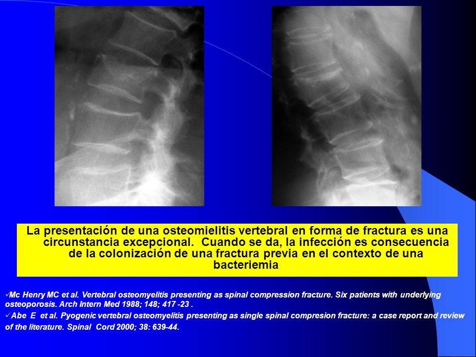 La presentación de una osteomielitis vertebral en forma de fractura es una circunstancia excepcional. Cuando se da, la infección es consecuencia de la colonización de una fractura previa en el contexto de una bacteriemia