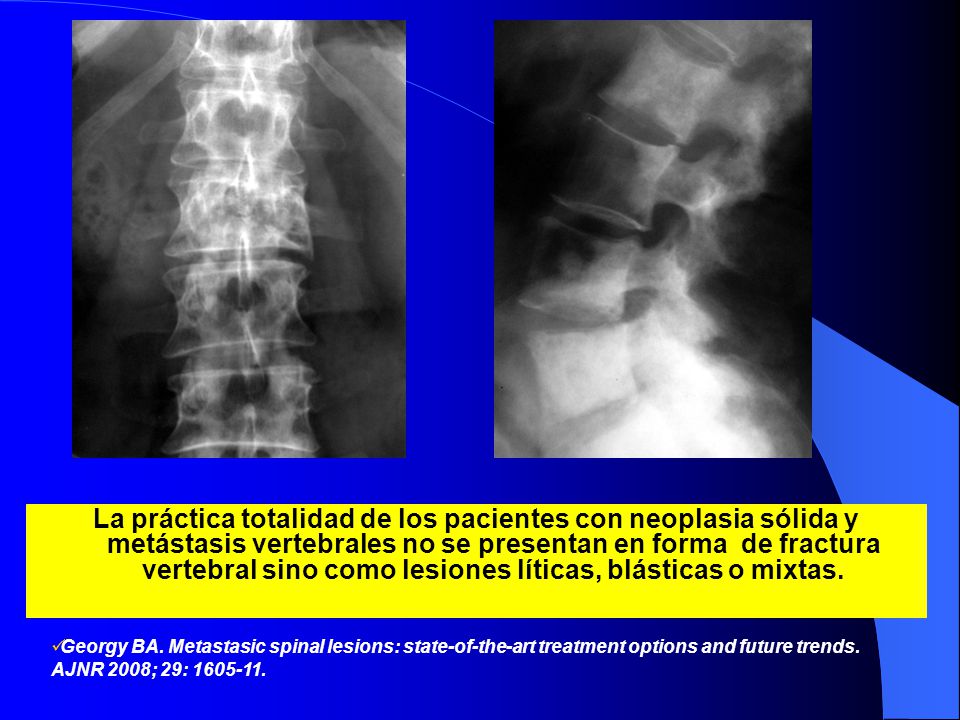 La práctica totalidad de los pacientes con neoplasia sólida y metástasis vertebrales no se presentan en forma de fractura vertebral sino como lesiones líticas, blásticas o mixtas.
