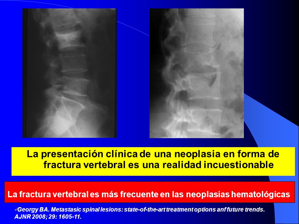 La presentación clínica de una neoplasia en forma de fractura vertebral es una realidad incuestionable