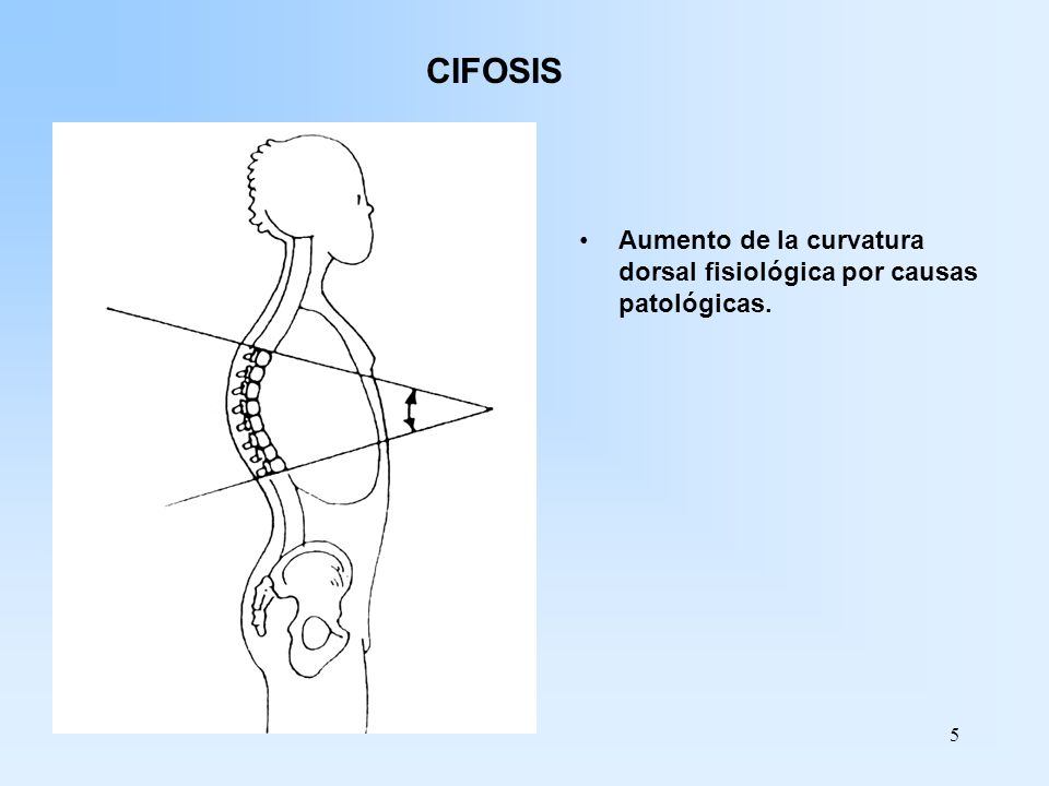 CIFOSIS Aumento de la curvatura dorsal fisiológica por causas patológicas.