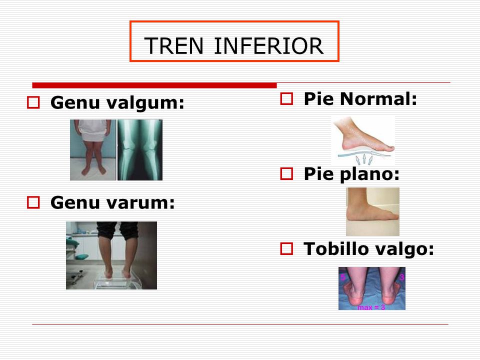 TREN INFERIOR Pie Normal: Genu valgum: Pie plano: Genu varum: