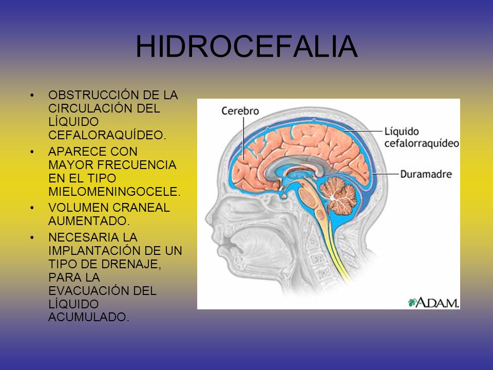 HIDROCEFALIA OBSTRUCCIÓN DE LA CIRCULACIÓN DEL LÍQUIDO CEFALORAQUÍDEO.