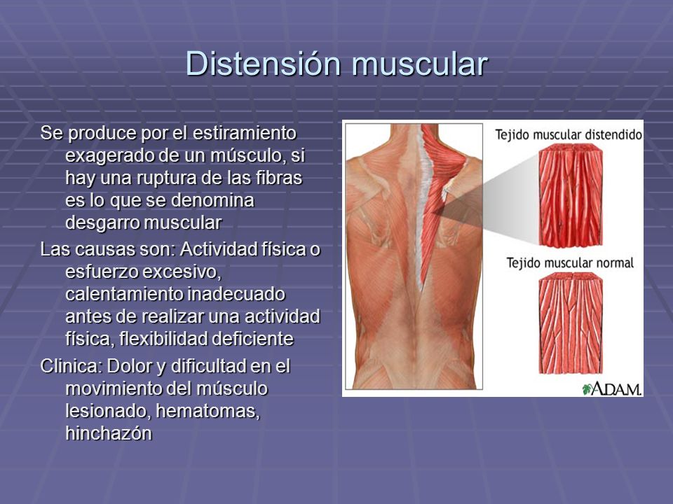 Distensión muscular Se produce por el estiramiento exagerado de un músculo, si hay una ruptura de las fibras es lo que se denomina desgarro muscular.