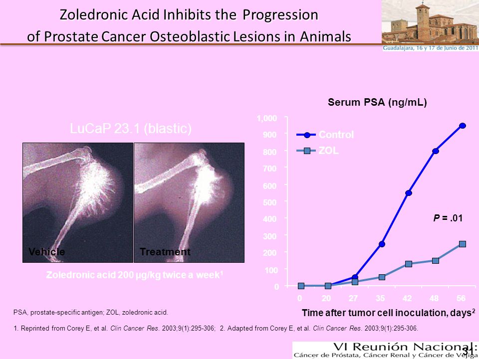 Zoledronic Acid Inhibits the Progression of Prostate Cancer Osteoblastic Lesions in Animals