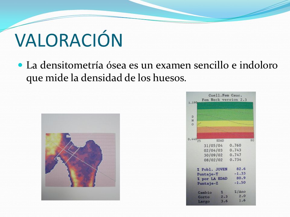 VALORACIÓN La densitometría ósea es un examen sencillo e indoloro que mide la densidad de los huesos.