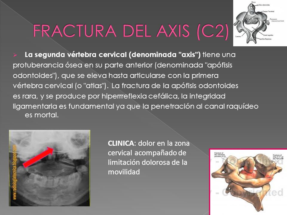 FRACTURA DEL AXIS (C2) La segunda vértebra cervical (denominada axis ) tiene una. protuberancia ósea en su parte anterior (denominada apófisis.