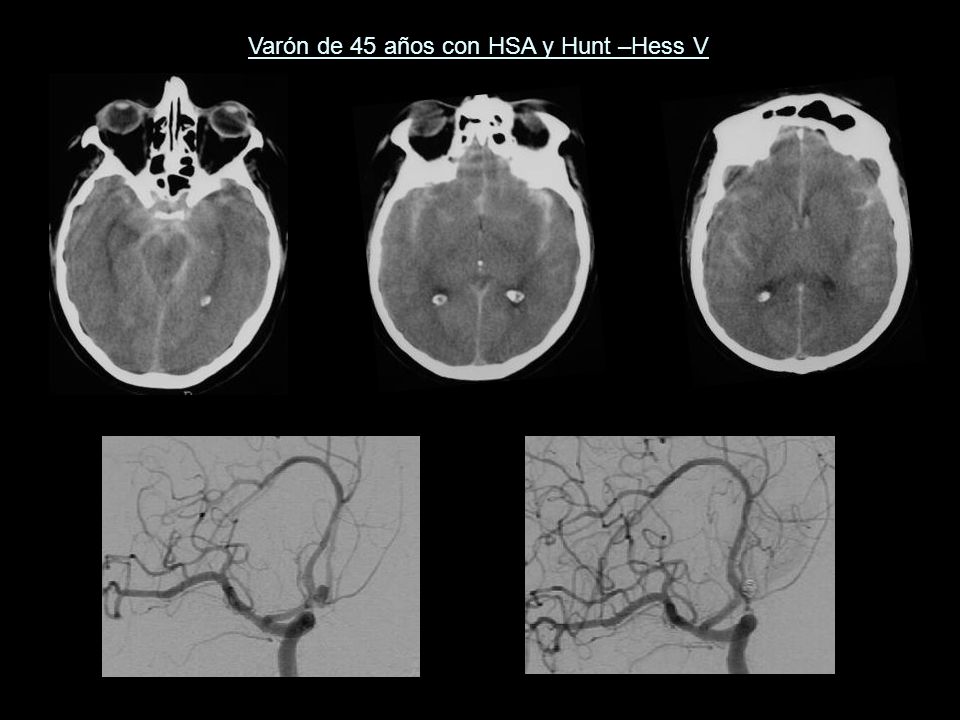 Varón de 45 años con HSA y Hunt –Hess V