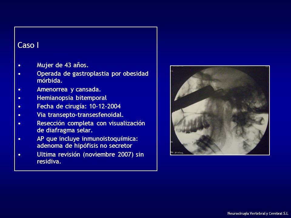 Caso I Mujer de 43 años. Operada de gastroplastia por obesidad mórbida. Amenorrea y cansada. Hemianopsia bitemporal.