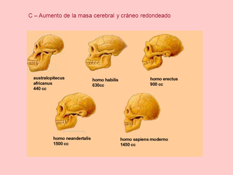 C – Aumento de la masa cerebral y cráneo redondeado